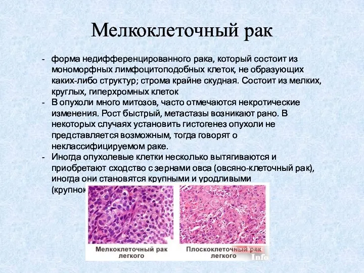 Мелкоклеточный рак форма недифференцированного рака, который состоит из мономорфных лимфоцитоподобных клеток,