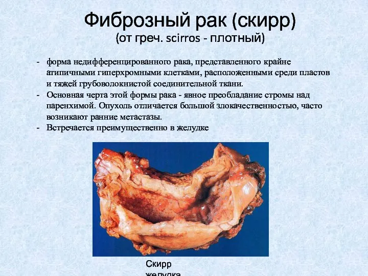 Фиброзный рак (скирр) (от греч. scirros - плотный) форма недифференцированного рака,