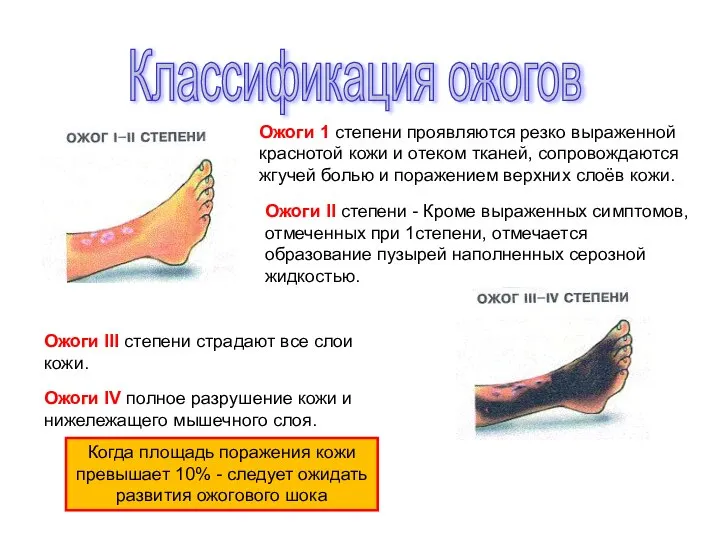 Ожоги 1 степени проявляются резко выраженной краснотой кожи и отеком тканей,