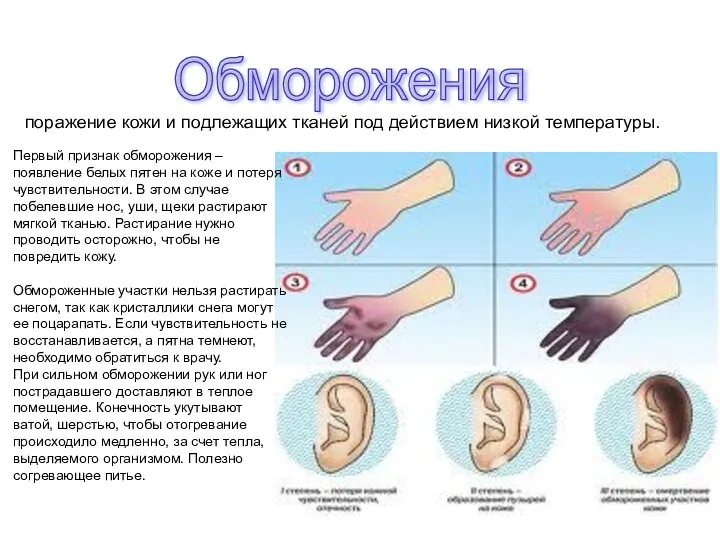 Обморожения поражение кожи и подлежащих тканей под действием низкой температуры. Первый