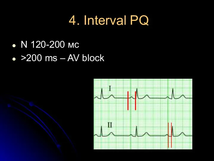 4. Interval PQ N 120-200 мс >200 ms – AV block