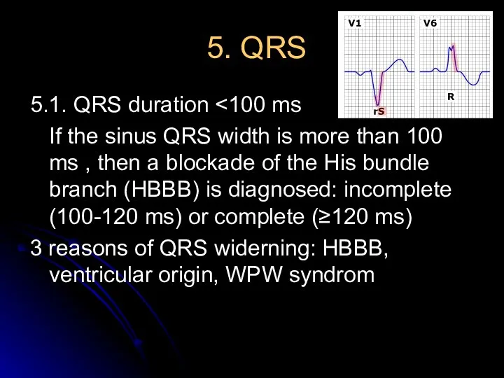 5. QRS 5.1. QRS duration If the sinus QRS width is