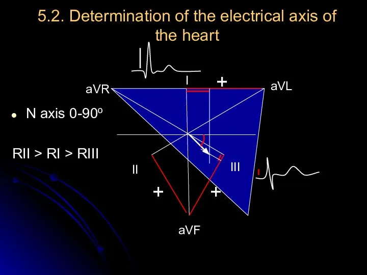 5.2. Determination of the electrical axis of the heart N axis