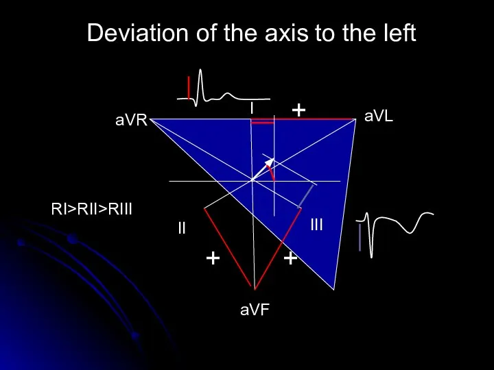 Deviation of the axis to the left aVL аVR aVF I