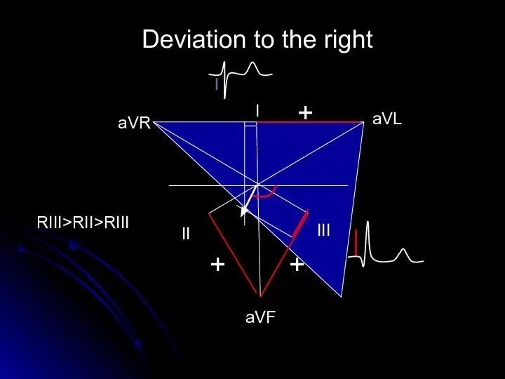 Deviation to the right aVL аVR aVF I II III + + + RIII>RII>RIII