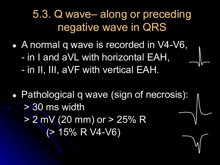 5.3. Q wave– along or preceding negative wave in QRS A