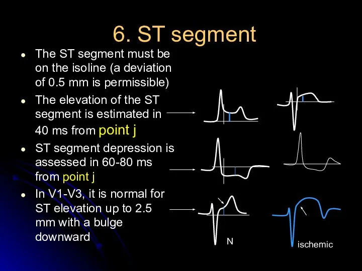 6. ST segment The ST segment must be on the isoline