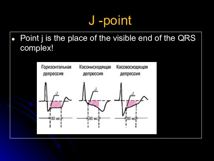 J -point Point j is the place of the visible end of the QRS complex! J-точка