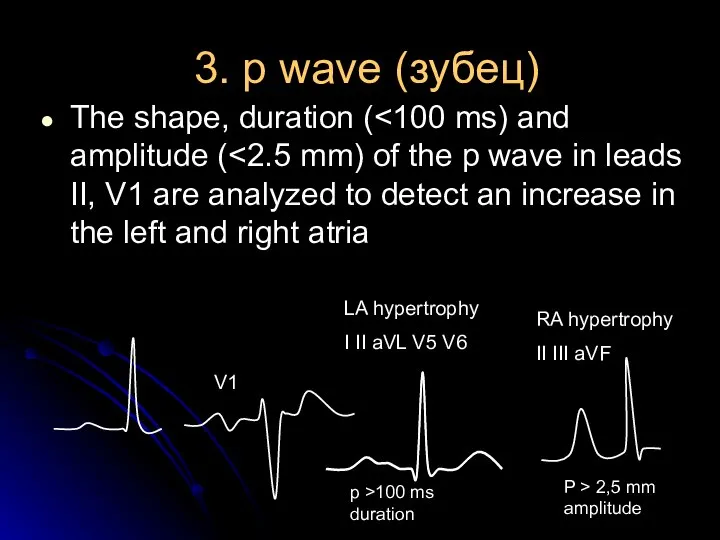 3. p wave (зубец) The shape, duration ( LA hypertrophy I