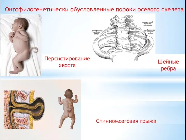 Онтофилогенетически обусловленные пороки осевого скелета Спинномозговая грыжа Шейные ребра Персистирование хвоста