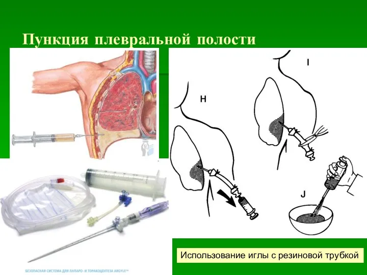 Пункция плевральной полости Использование иглы с резиновой трубкой