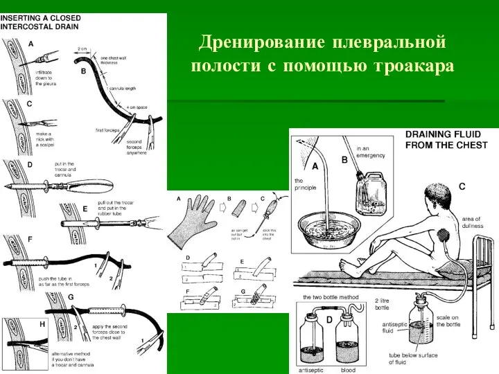 Дренирование плевральной полости с помощью троакара