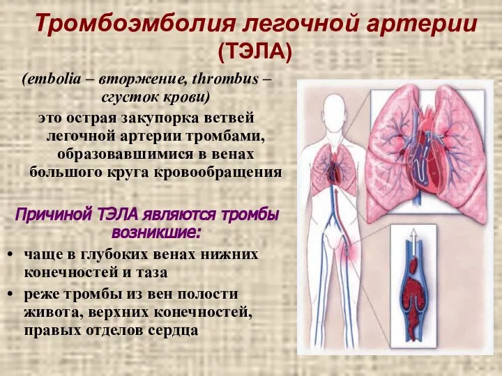 Тромбоэмболия легочной артерии (ТЭЛА) (embolia – вторжение, thrombus – сгусток крови)