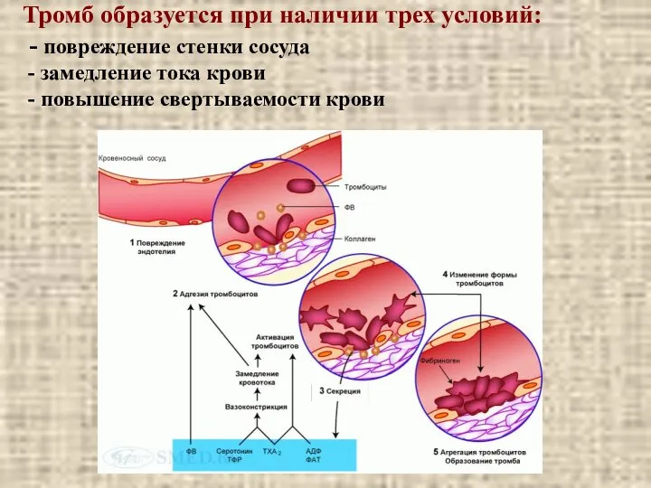 Тромб образуется при наличии трех условий: - повреждение стенки сосуда -