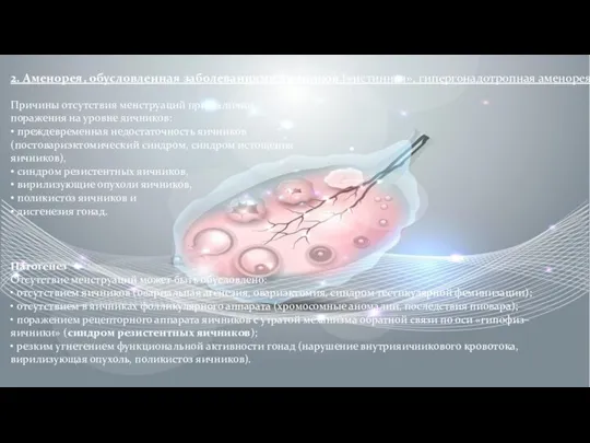 2. Аменорея, обусловленная заболеваниями яичников («истинная», гипергонадотропная аменорея) Причины отсутствия менструаций