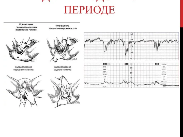 ВЕДЕНИЕ РОДОВ ВО II ПЕРИОДЕ