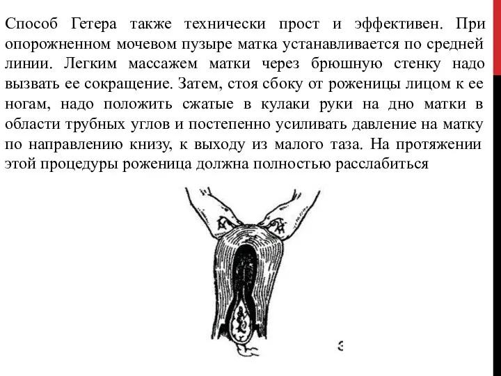 Способ Гетера также технически прост и эффективен. При опорожненном мочевом пузыре