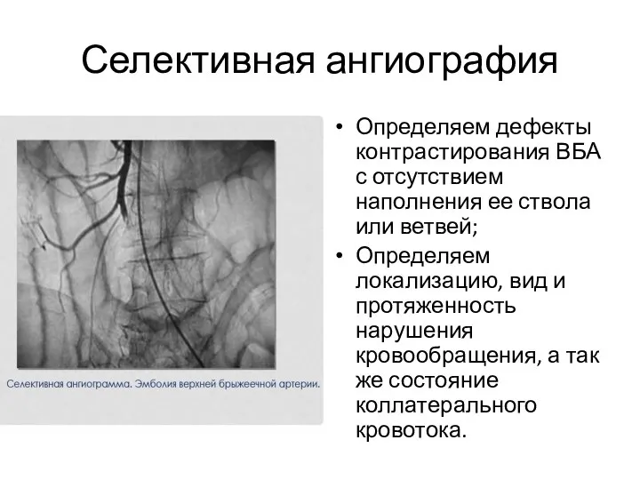 Селективная ангиография Определяем дефекты контрастирования ВБА с отсутствием наполнения ее ствола