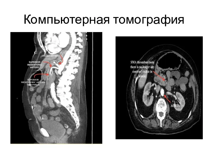 Компьютерная томография