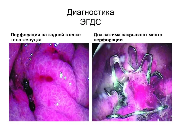 Диагностика ЭГДС Перфорация на задней стенке тела желудка Два зажима закрывают место перфорации