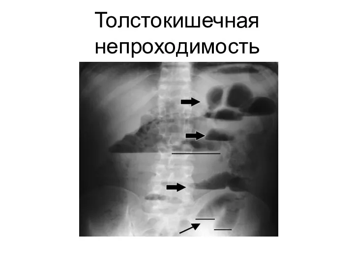 Толстокишечная непроходимость