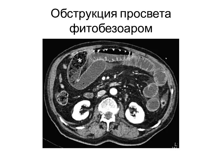 Обструкция просвета фитобезоаром