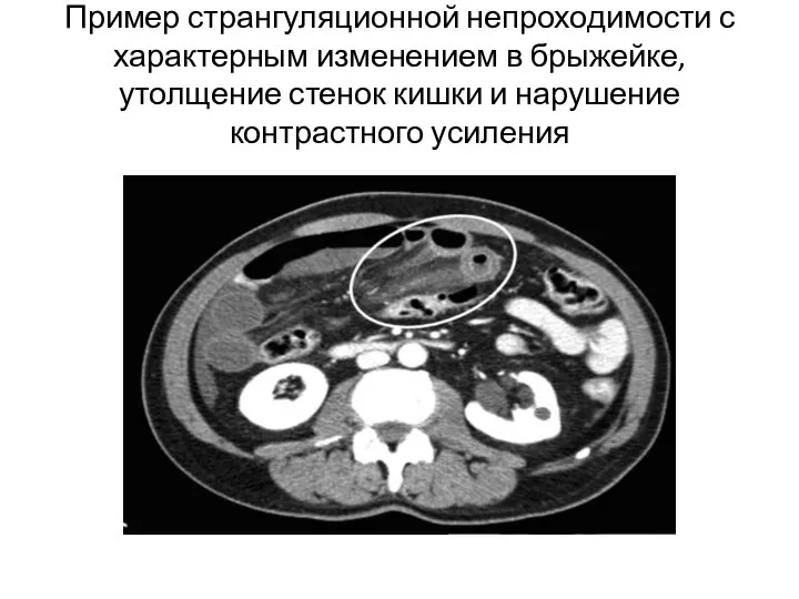 Пример странгуляционной непроходимости с характерным изменением в брыжейке, утолщение стенок кишки и нарушение контрастного усиления