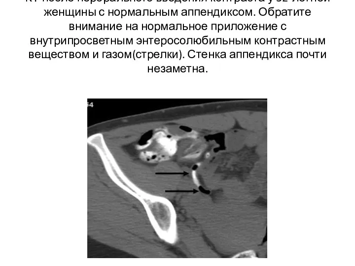 КТ после перорального введения контраста у 32-летней женщины с нормальным аппендиксом.
