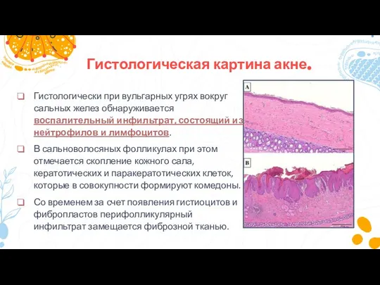 03 06 Гистологическая картина акне. Гистологически при вульгарных угрях вокруг сальных