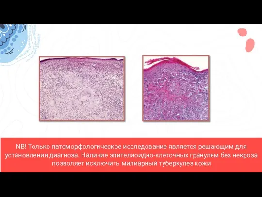 NB! Только патоморфологическое исследование является решающим для установления диагноза. Наличие эпителиоидно-клеточных