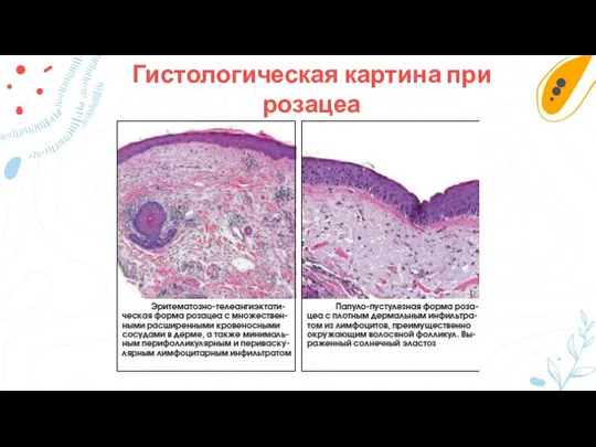 Гистологическая картина при розацеа