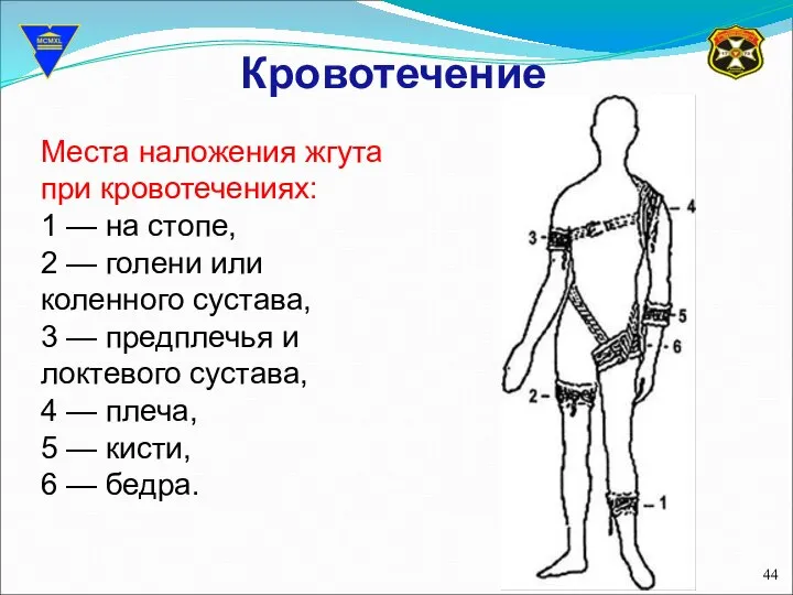 Кровотечение Места наложения жгута при кровотечениях: 1 — на стопе, 2