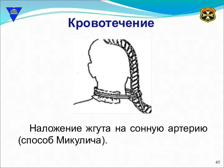 Кровотечение Наложение жгута на сонную артерию (способ Микулича).