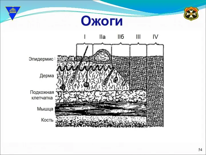 Ожоги