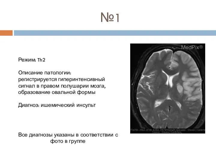 №1 Режим: Th2 Описание патологии: регистрируется гиперинтенсивный сигнал в правом полушарии