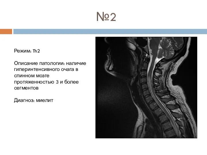 №2 Режим: Th2 Описание патологии: наличие гиперинтенсивного очага в спинном мозге