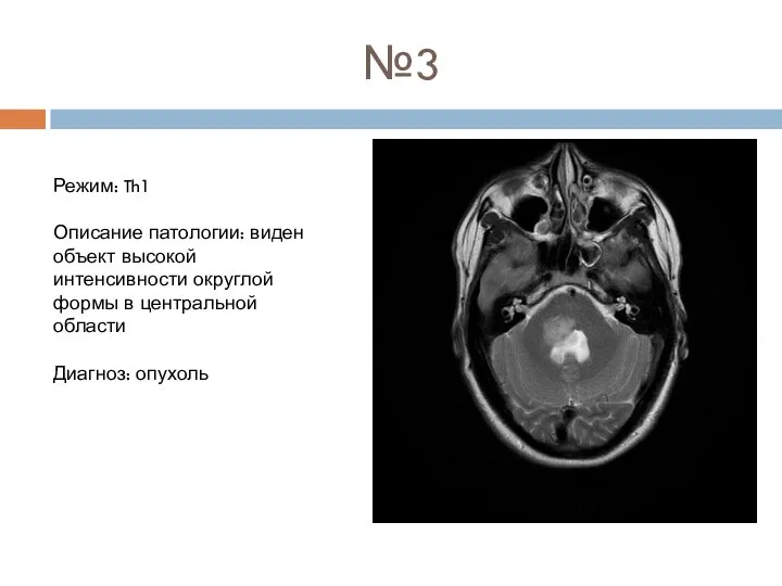 №3 Режим: Th1 Описание патологии: виден объект высокой интенсивности округлой формы в центральной области Диагноз: опухоль