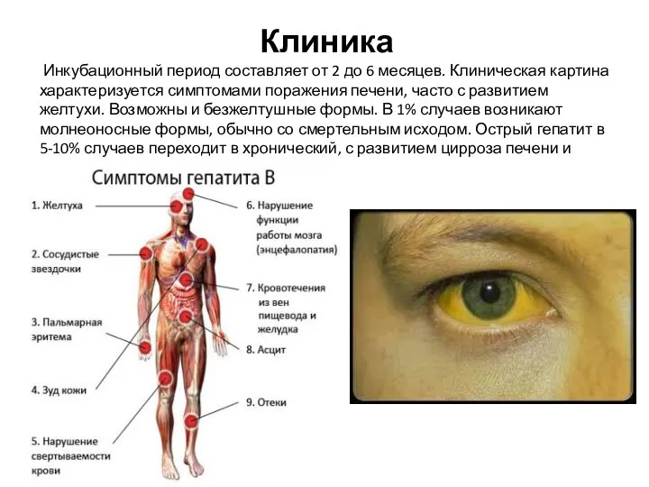 Клиника Инкубационный период составляет от 2 до 6 месяцев. Клиническая картина