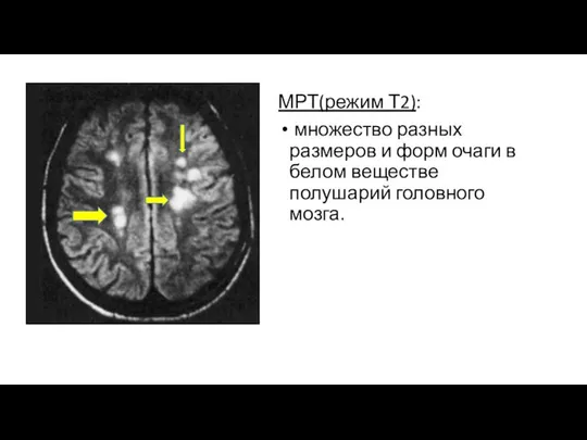 МРТ(режим Т2): множество разных размеров и форм очаги в белом веществе полушарий головного мозга.