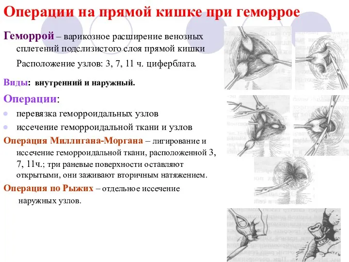 Операции на прямой кишке при геморрое Геморрой – варикозное расширение венозных