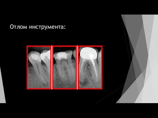 Отлом инструмента: