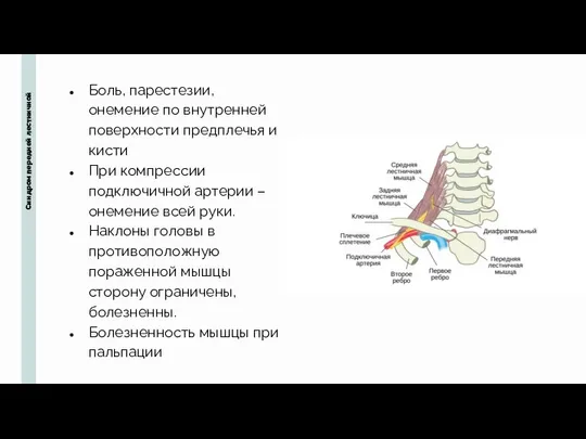 Синдром передней лестничной Боль, парестезии, онемение по внутренней поверхности предплечья и