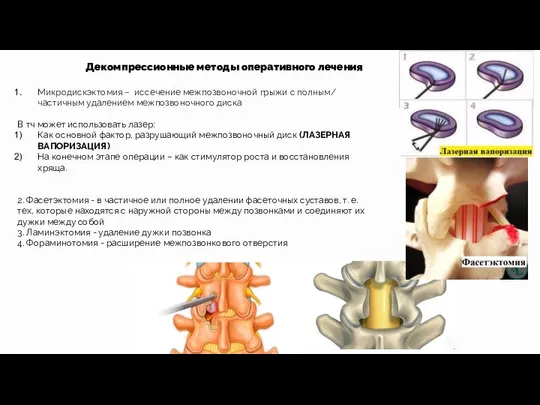 Декомпрессионные методы оперативного лечения Микродискэктомия – иссечение межпозвоночной грыжи с полным/