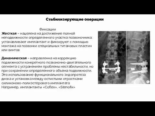 Стабилизирующие операции Фиксации Жесткая – нацелена на достижение полной неподвижности определенного