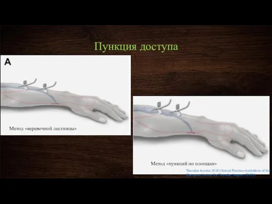 Пункция доступа Метод «веревочной лестницы» Метод «пункций по площади» Vascular Access: