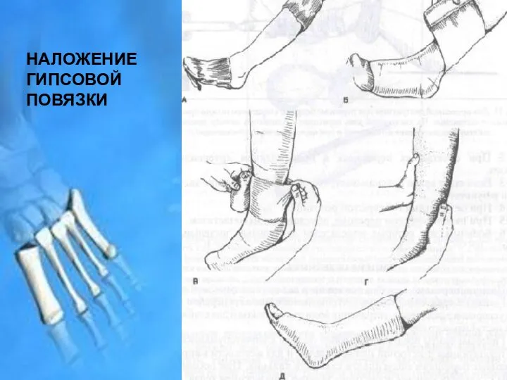 НАЛОЖЕНИЕ ГИПСОВОЙ ПОВЯЗКИ