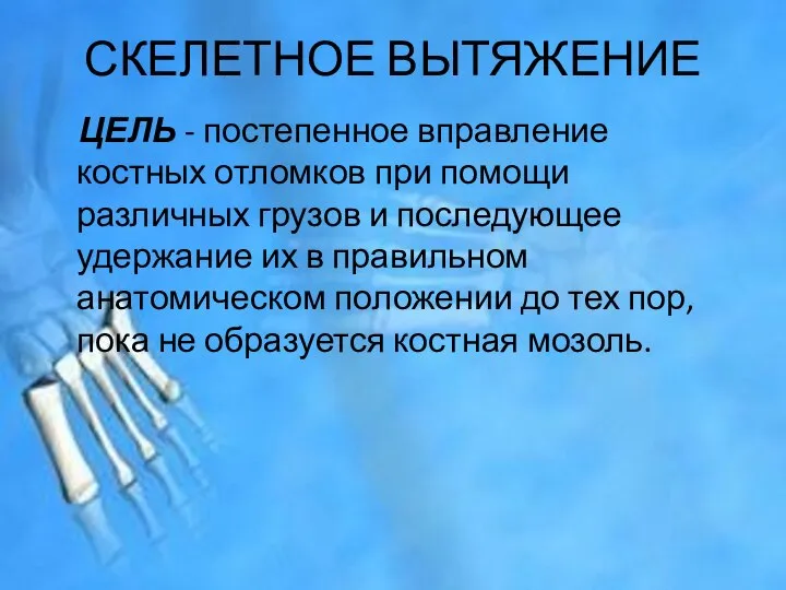 СКЕЛЕТНОЕ ВЫТЯЖЕНИЕ ЦЕЛЬ - постепенное вправление костных отломков при помощи различных