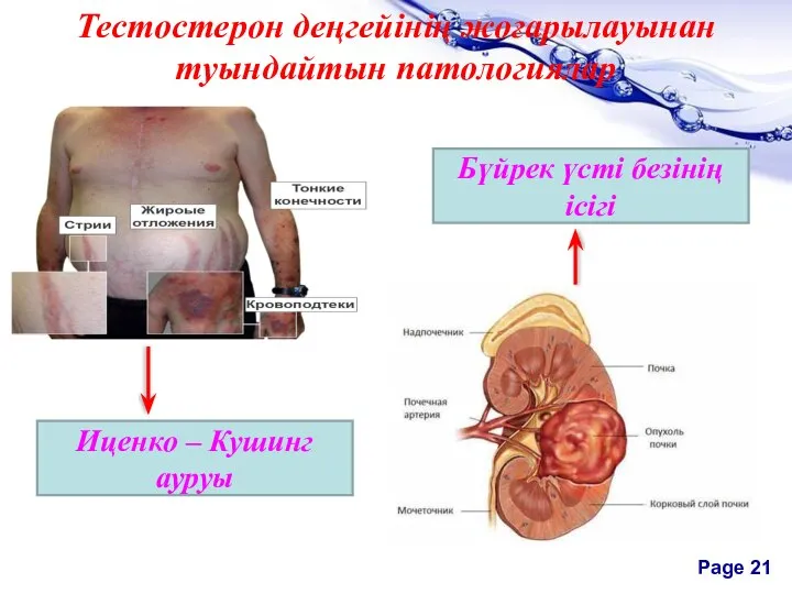 Тестостерон деңгейінің жоғарылауынан туындайтын патологиялар Иценко – Кушинг ауруы Бүйрек үсті безінің ісігі