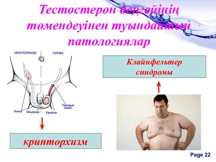 Тестостерон деңгейінің төмендеуінен туындайтын патологиялар крипторхизм Клайнфельтер синдромы