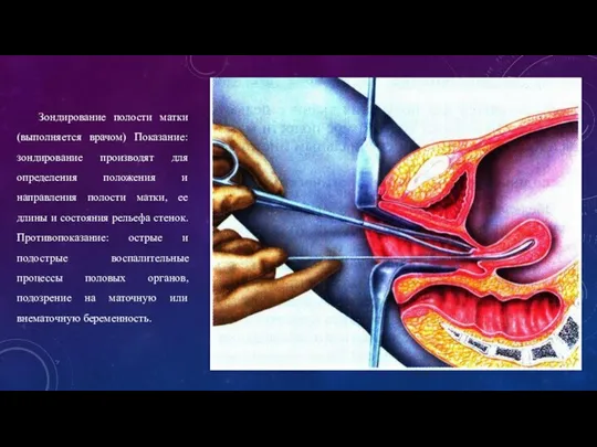 Зондирование полости матки (выполняется врачом) Показание: зондирование производят для определения положения